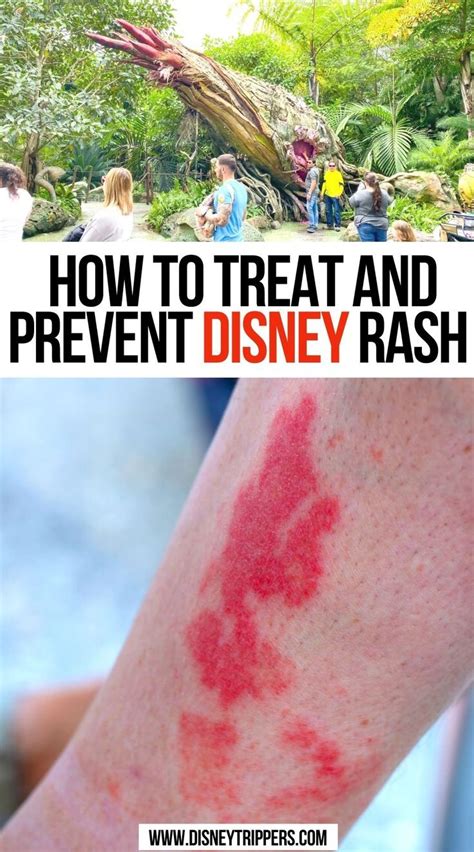 How To Treat And Prevent Disney Rash In 2021 Disney Rash Travel Fun