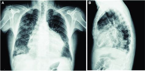Chest X Ray Showing Marked Cardiomegaly Signs Of Pulmonary Congestion