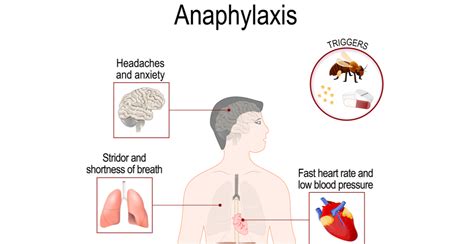 What Is Anaphylaxis Signs Symptoms And Dangers