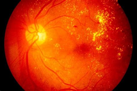 Understanding retinopathy: Senescence-associated secretory phenotype ...
