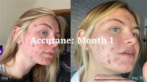 My Accutane Journey Month 1 Youtube