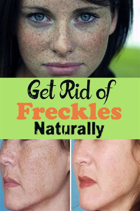 Get Rid Of Freckles Naturally Getting Rid Of Freckles Brown Spots On