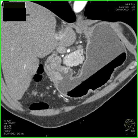 Carcinoma Of The Antrum Of The Stomach Gastrointestinal Case Studies