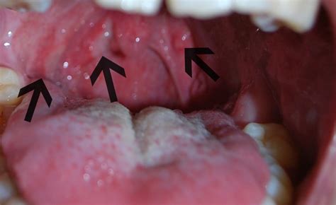 Swollen Uvula And Bumps On Back Of Tongue Sore