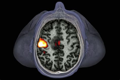 Thousands Of Fmri Brain Studies In Doubt Due To Software Flaws New
