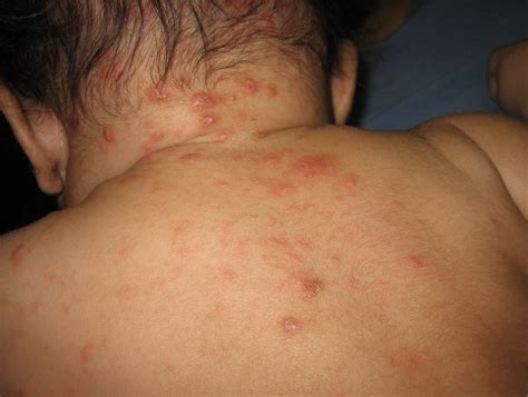 Scabies Rash On Stomach
