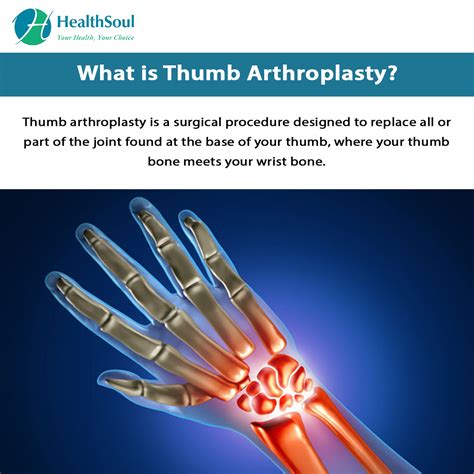 Thumb Arthroplasty Learn About The Procedure Healthsoul