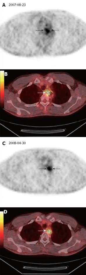 Clinical Usefulness Of 18f Fdg Petct In The Restaging Of Esophageal