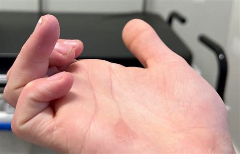 Orthodx Jersey Finger Clinical Advisor