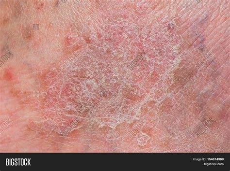 Psoriasis Skin Image And Photo Free Trial Bigstock