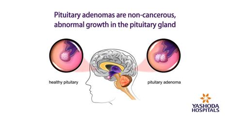 Pituitary Gland Tumors Important Things To Know About