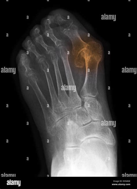 X Ray Of The Foot Of An Year Old Woman Showing A Severe Bunion Deformity Stock Photo Alamy