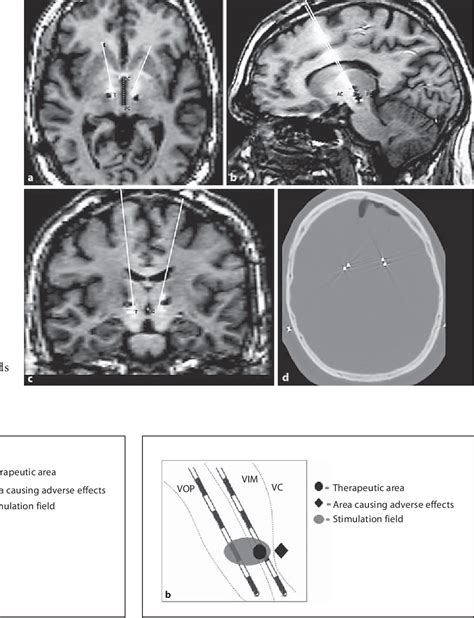 Figure 1 From Confined Stimulation Using Dual Thalamic Deep Brain