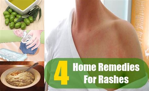 4 Home Remedies For Rashes Natural Treatments Cure For Rashes