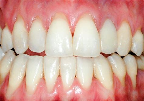 Gingival Recession Its Causes And Types And The Importance Of