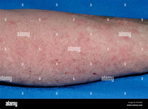 Skin Rash Of Eczema On The Forearm Of A 55 Year Old Man Stock Photo Alamy