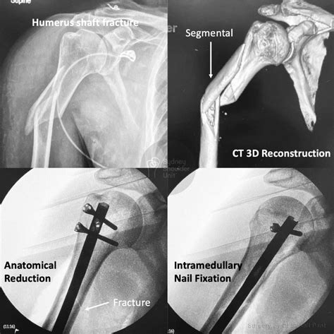 Shoulder Fracture Proximal Humerus Medical Case Study