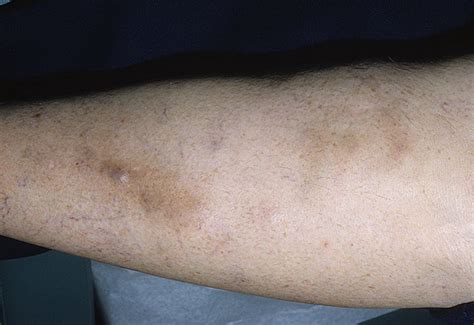 Phlebitis Early Stages Pictures 14 Photos And Images