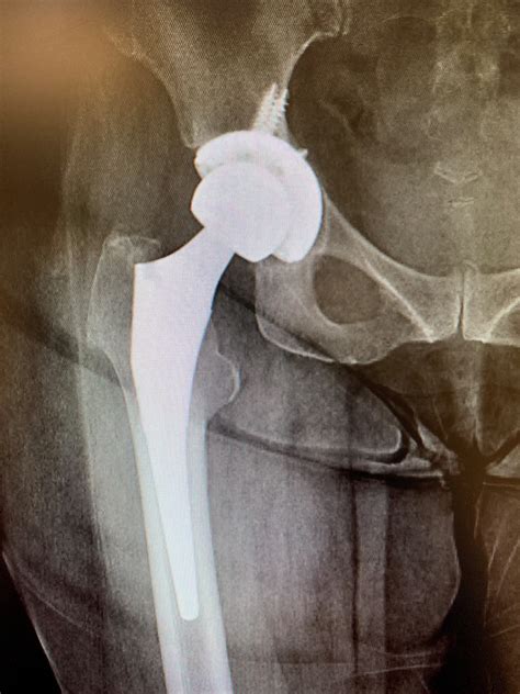 Case Study: Revision Total Hip Replacement in a 64year old. Isolated ...