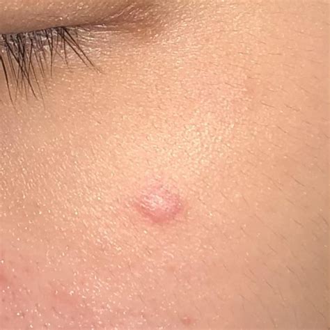 Had This Bump On My Face For 2 Years Now Dermatologist Says Its