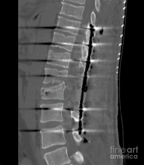 Spinal Fusion Surgery For Broken Back Photograph By Zephyrscience Photo Library