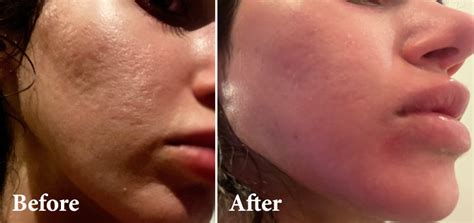 Treating Acne Scars With Co2 Laser Therapy Lmc