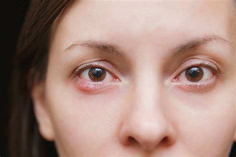 How To Get Rid Of A Stye Valley Eyecare Center Eye Doctors In