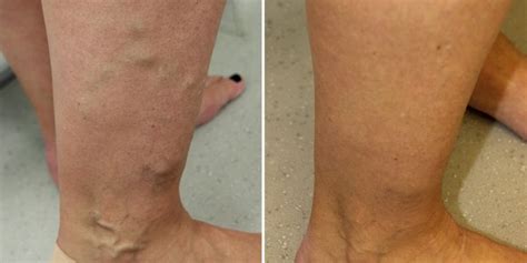 Nhs Classes Varicose Veins As Cosmetic London Vein Centre
