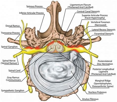 Neural Foraminal Stenosis Causes Symptoms Diagnosis Treatment