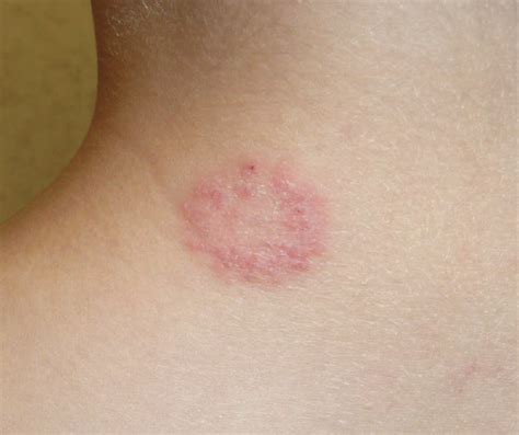 An Itchy Round Rash On The Back Of An Adolescents Neck Consultant360