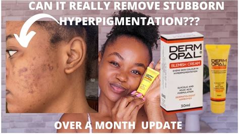 Dermopal Blemish Cream For Over A Month And I Have Thoughts