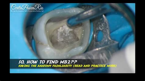 Finding The MB2 Canal In Maxillary Molar Ultrasonic Tip ET18D Satelec