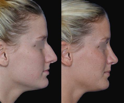 Rhinoplasty To Remove A Hump On The Bridge Of The Nose
