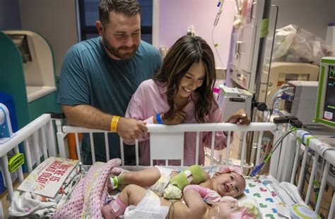 Conjoined Twins Survived A Rare Surgery Now Theyre Going Home Rmedicalnews