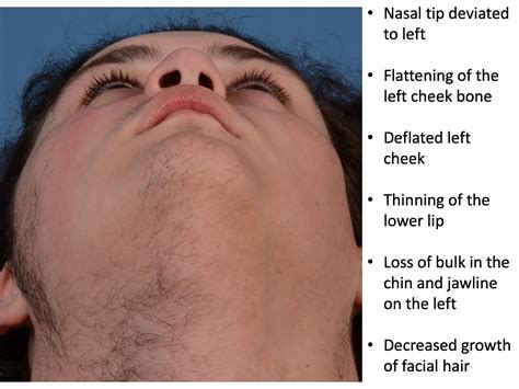Parry Romberg Syndrome Linear Scleroderma — Dallas Pediatric Plastic