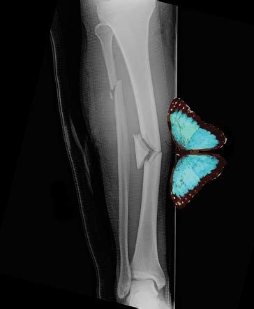 Butterfly Fragment Fracture Radiology Reference Article