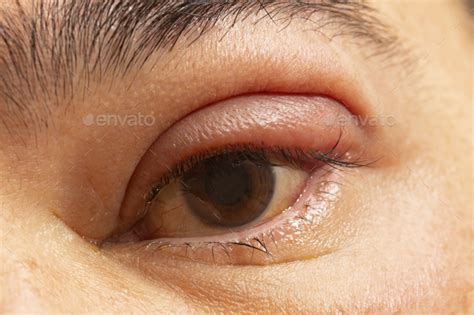 Inflamed Eye With Infected Stye Upper Eyelid Ophthalmic Medicine