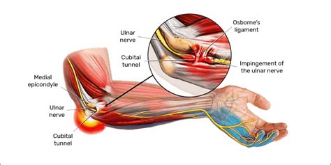 Ulnar Nerve Entrapment Cubital Tunnel Syndrome Usasc And Orthopedics