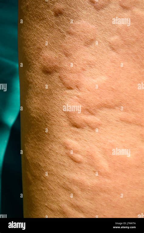 Skin Rash Urticaria Allergic Skin Reaction Stock Photo Alamy