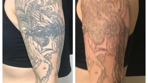 What To Expect From Laser Tattoo Removal Times Frontier