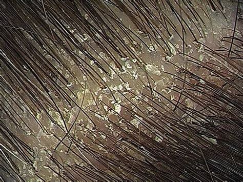 Sebum Buildup On Scalp