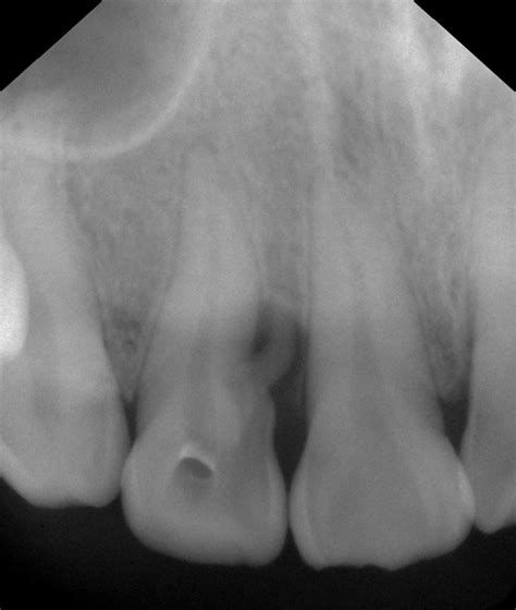 The Preoperative X Ray Picture Showed That Apical Periodontal Widening