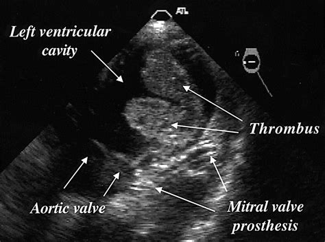 Fulminant Thrombosis Of Mechanical Mitral Valve Prosthesis Heart