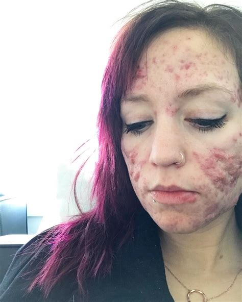 Local Woman Shares Battle With Severe Acne On Social Media