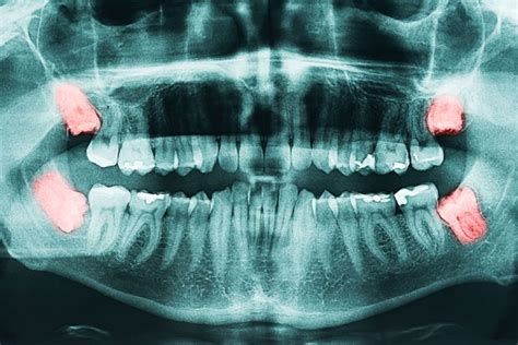 Frequently Asked Questions About Wisdom Teeth