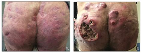 Squamous Cell Carcinoma In Hidradenitis Suppurativa Lesions Following