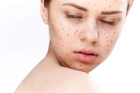 Causes Of Small Red Dots On Skin And Treatment Charlies Magazines