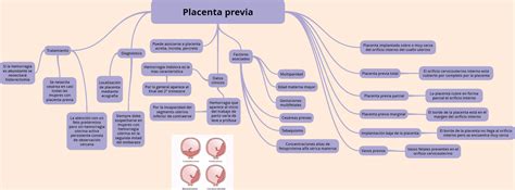 Placenta Previa En Este Mapa Conceptual Se Elistan Los Puntos Clave