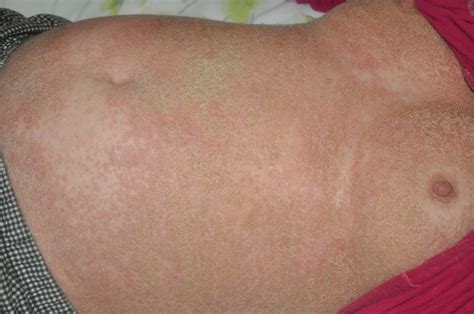 Treatment Of Generalized Pustular Psoriasis Of Pregnancy With
