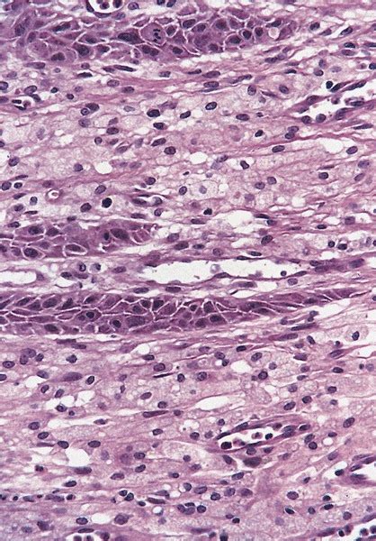Pathology Outlines Cutaneous Verruciform Xanthoma